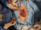 Девочке, пострадавшей при атаке ВСУ на Черниговский район, сделали операцию на позвоночнике