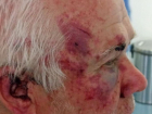 Опубликованы жуткие фото последствий избиения пенсионера разъяренным дачником в Запорожье