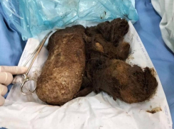 Огромный волосяной ком извлекли из кишечника 15-летней девочки из Запорожья