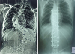 Девочке-подростку из Запорожской области 4 часа исправляли искривление позвоночника 