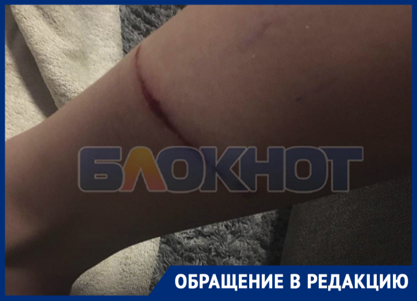 Появилось фото жуткого последствия нападения бездомных псов на жительницу Днепрорудного